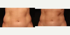 Body Lift procedure image