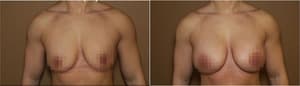 Breast Augmentation procedure image