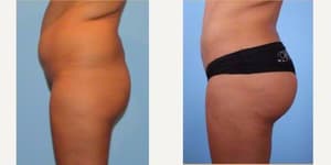 Brazilian Butt Lift (BBL) procedure image