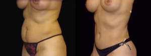 Tummy Tuck (Abdominoplasty) procedure image