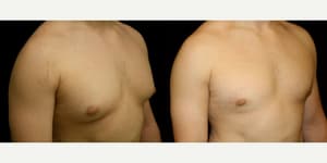 Mommy Makeover procedure image