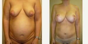 Tummy Tuck (Abdominoplasty) procedure image