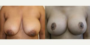 Mommy Makeover procedure image