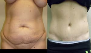 Breast Augmentation procedure image