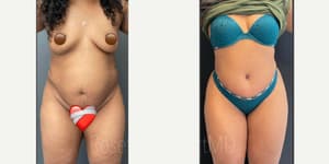 Tummy Tuck (Abdominoplasty) procedure image