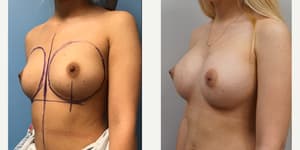 Breast Augmentation procedure image