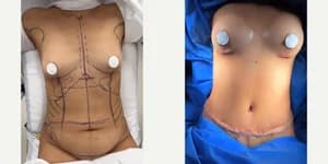 Breast Augmentation procedure image