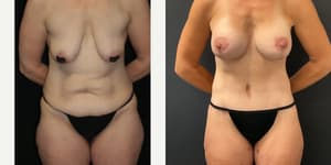 Tummy Tuck (Abdominoplasty) procedure image