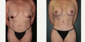 Breast Augmentation procedure image