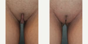Vaginal Rejuvenation procedure image