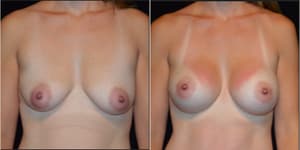 Mommy Makeover procedure image