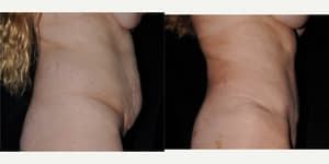 Tummy Tuck (Abdominoplasty) procedure image