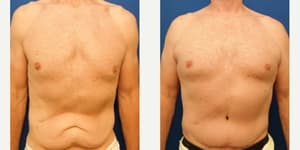 Skin Tightening procedure image