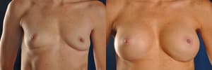 Breast Augmentation procedure image