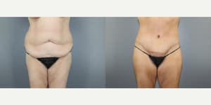 Mommy Makeover procedure image