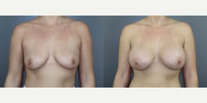 Breast Augmentation procedure image