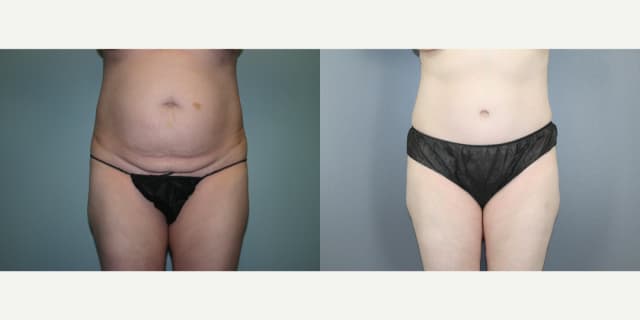 Skin Tightening procedure image