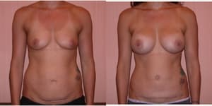 Mommy Makeover procedure image