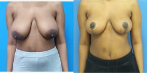 Mommy Makeover procedure image