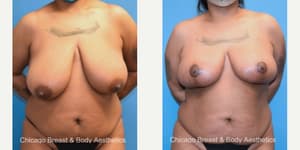 Mommy Makeover procedure image