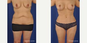 Mommy Makeover procedure image