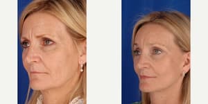 Facelift procedure image