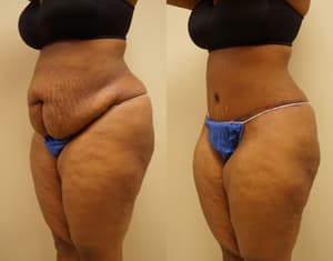 Tummy Tuck (Abdominoplasty) procedure image