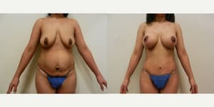 Breast Augmentation procedure image
