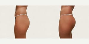 Brazilian Butt Lift (BBL) procedure image