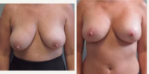 Mommy Makeover procedure image