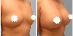 Breast Augmentation procedure image