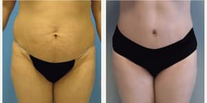 Tummy Tuck (Abdominoplasty) procedure image