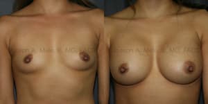 Breast Augmentation procedure image