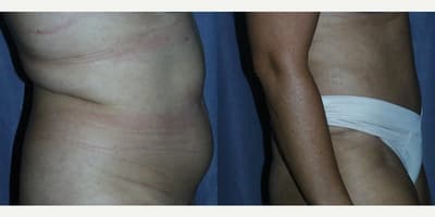 Mommy Makeover procedure image