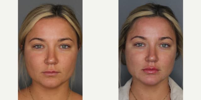 Fillers & Injectables (e.g. Botox, Juvederm) procedure image