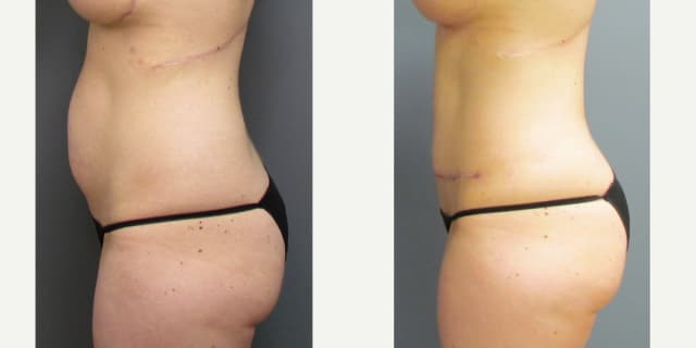 Tummy Tuck (Abdominoplasty) procedure image