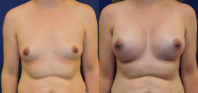 Breast Augmentation procedure image