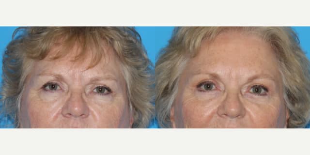 Eyelid Surgery (Blepharoplasty) procedure image