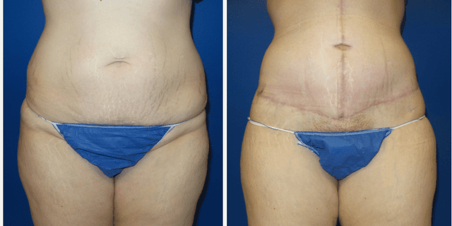 Tummy Tuck (Abdominoplasty) procedure image