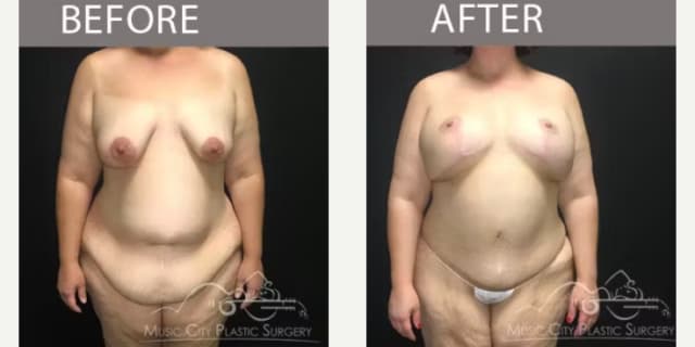 Skin Tightening procedure image