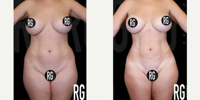 Body Lift procedure image