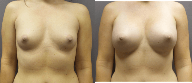 Mommy Makeover procedure image