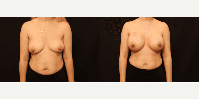 Breast Augmentation procedure image