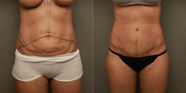 Tummy Tuck (Abdominoplasty) procedure image