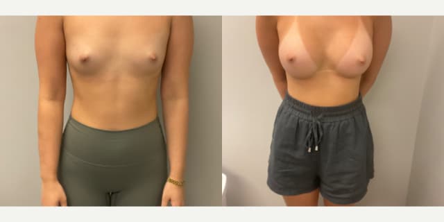 Liposuction procedure image