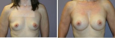 Breast Augmentation procedure image