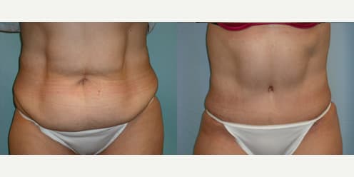 Mommy Makeover procedure image