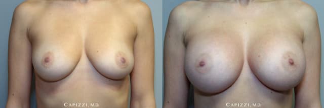 Breast Augmentation procedure image