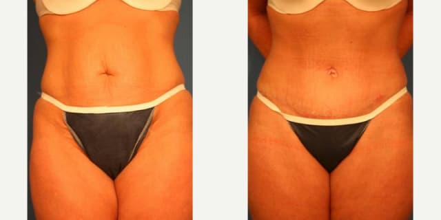 Skin Tightening procedure image