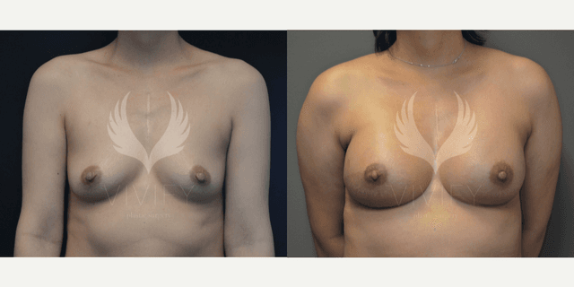 Breast Implants (Saline/Silicone) procedure image